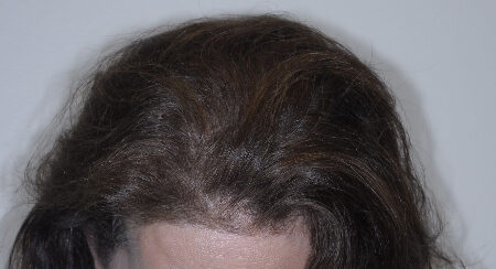 After Image: Patient # 85576 - front