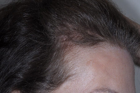 After Image: Patient # 85576 - right-side