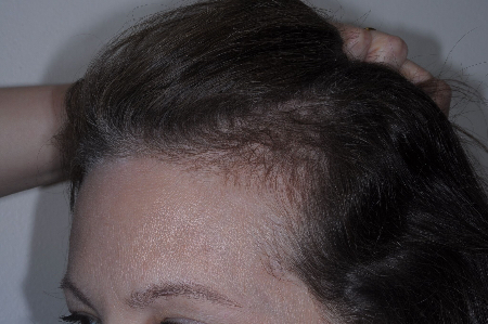 After Image: Patient # 85576 - left-front-oblique