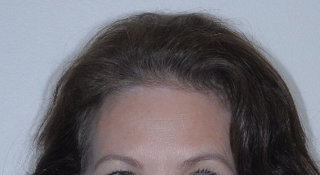 After Image: Patient # 85576 - front
