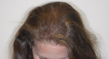 Before Image: Patient # 85576 - front