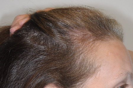 Before Image: Patient # 85576 - right-side