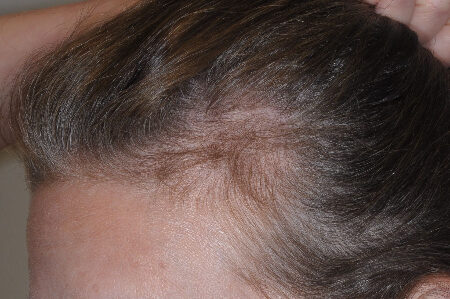 Before Image: Patient # 85576 - left-front-oblique