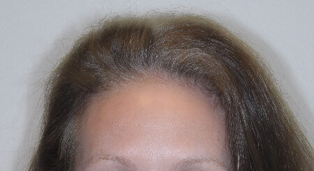 Before Image: Patient # 85576 - front