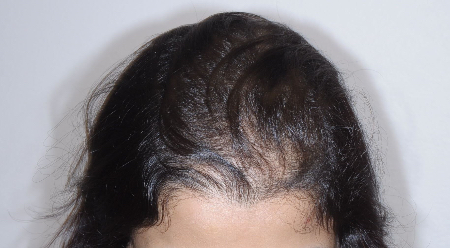 After Image: Patient # 87828 - front