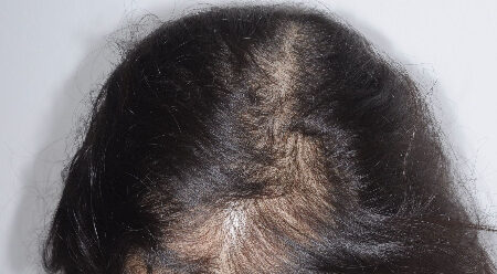 Before Image: Patient # 87828 - front