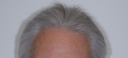 After Image: Patient # 96843 - front