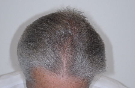 After Image: Patient # 96843 - front