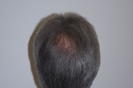 After Image: Patient # 96843 - back