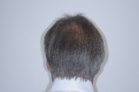 After Image: Patient # 96843 - back