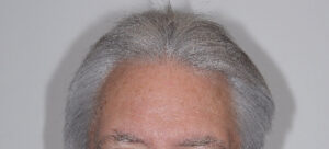 Before Image: Patient # 96843