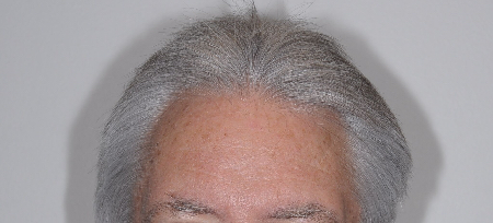 Before Image: Patient # 96843 - front