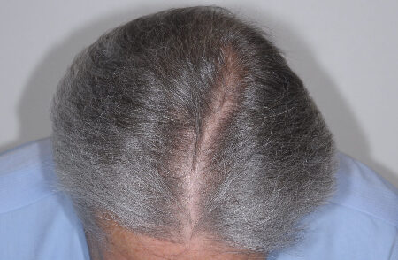 Before Image: Patient # 96843 - front