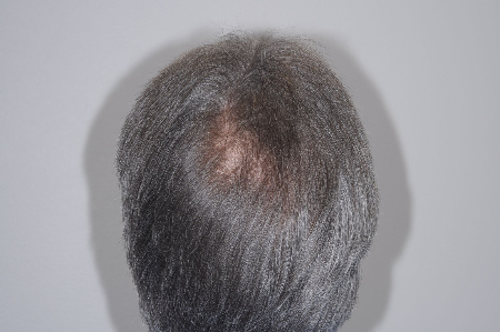 Before Image: Patient # 96843 - back