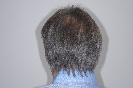 Before Image: Patient # 96843 - back