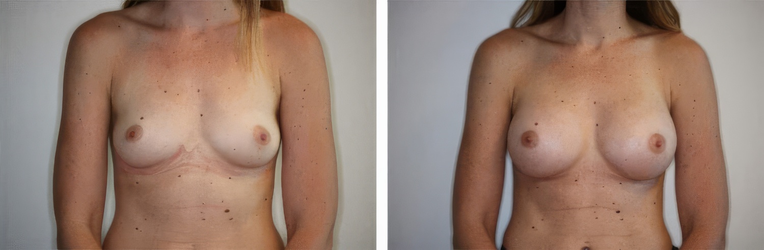 original BreastAug1 1024x336Edit