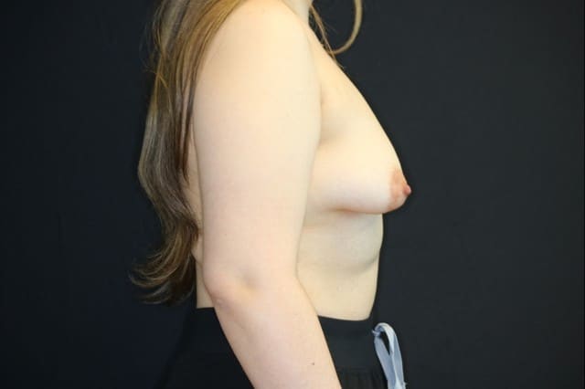 Before Image: Patient # 4182 - right-side