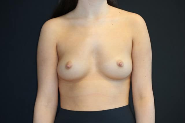 Before Image: Patient # 4184 - front