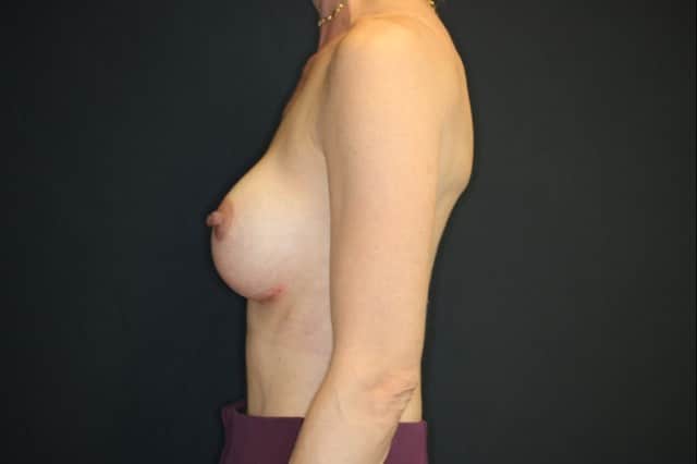 After Image: Patient # 4194 - left-side