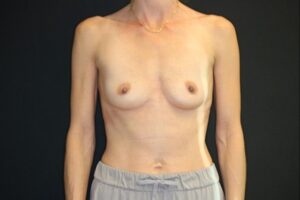 Before Image: Patient # 4194