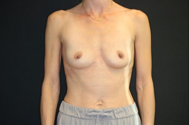 Before Image: Patient # 4194 - front
