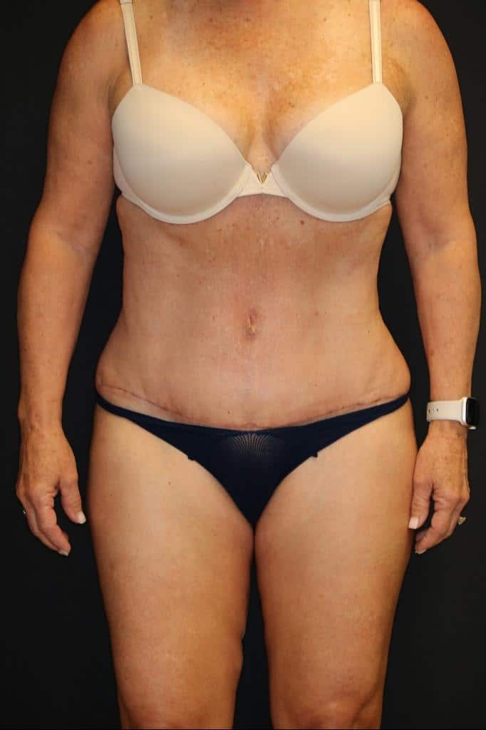 After Image: Patient #4171 - front