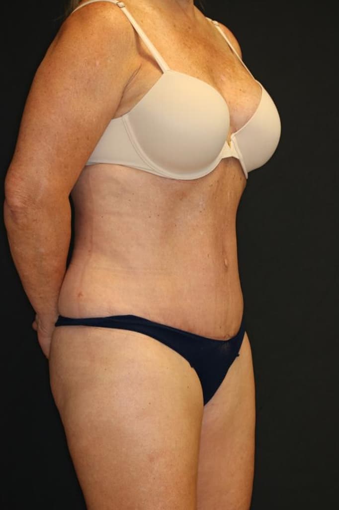 After Image: Patient #4171 - right-front-oblique