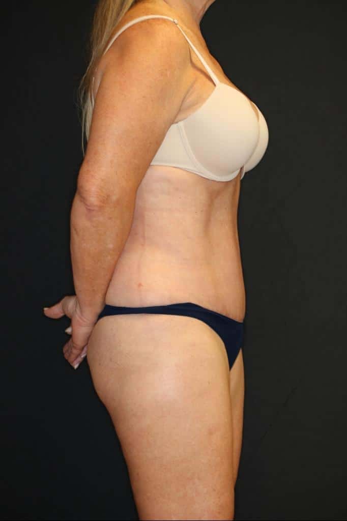 After Image: Patient #4171 - right-side