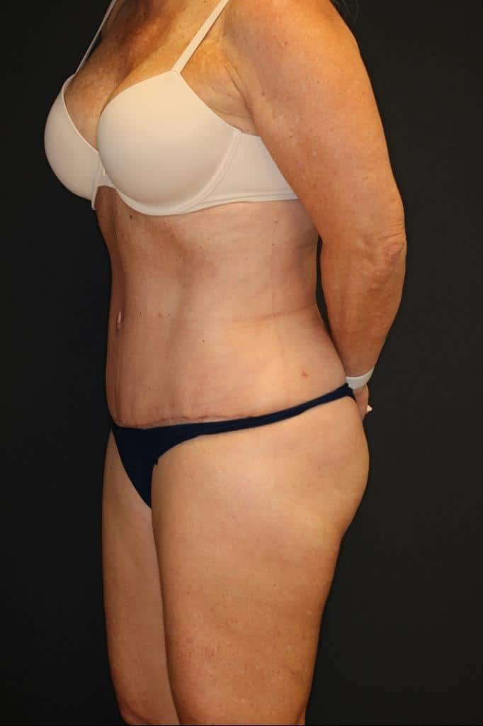 After Image: Patient #4171 - left-front-oblique