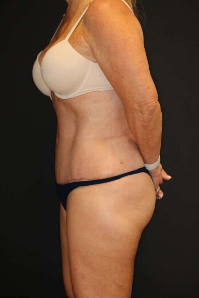 After Image: Patient #4171 - left-side