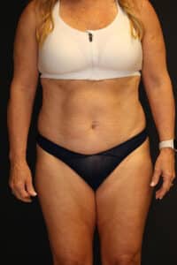 Before Image: Patient #4171