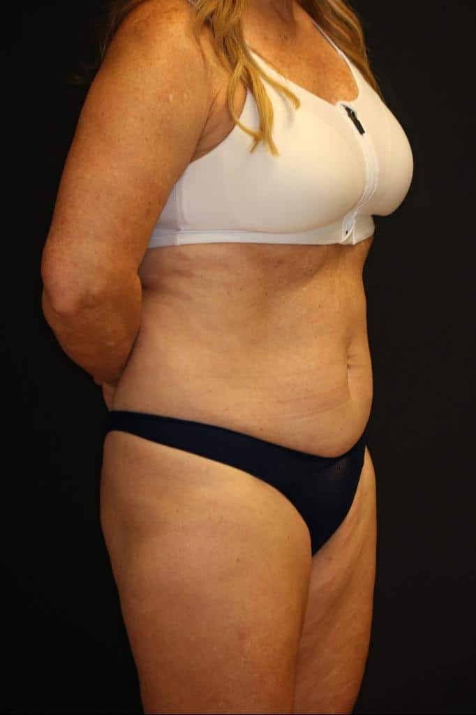 Before Image: Patient #4171 - right-front-oblique