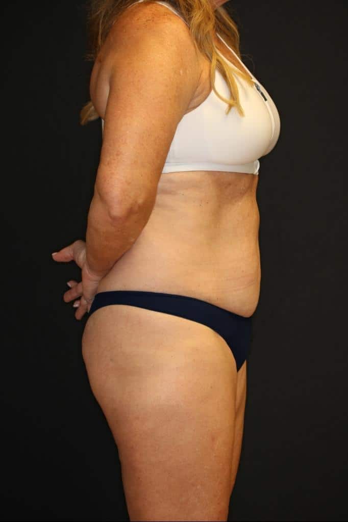 Before Image: Patient #4171 - right-side