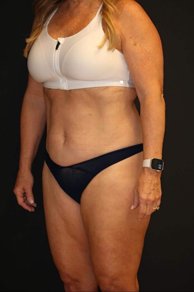 Before Image: Patient #4171 - left-front-oblique