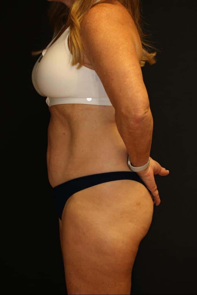 Before Image: Patient #4171 - left-side