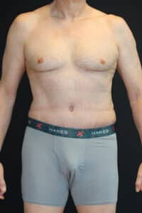 After Image: Patient #4160
