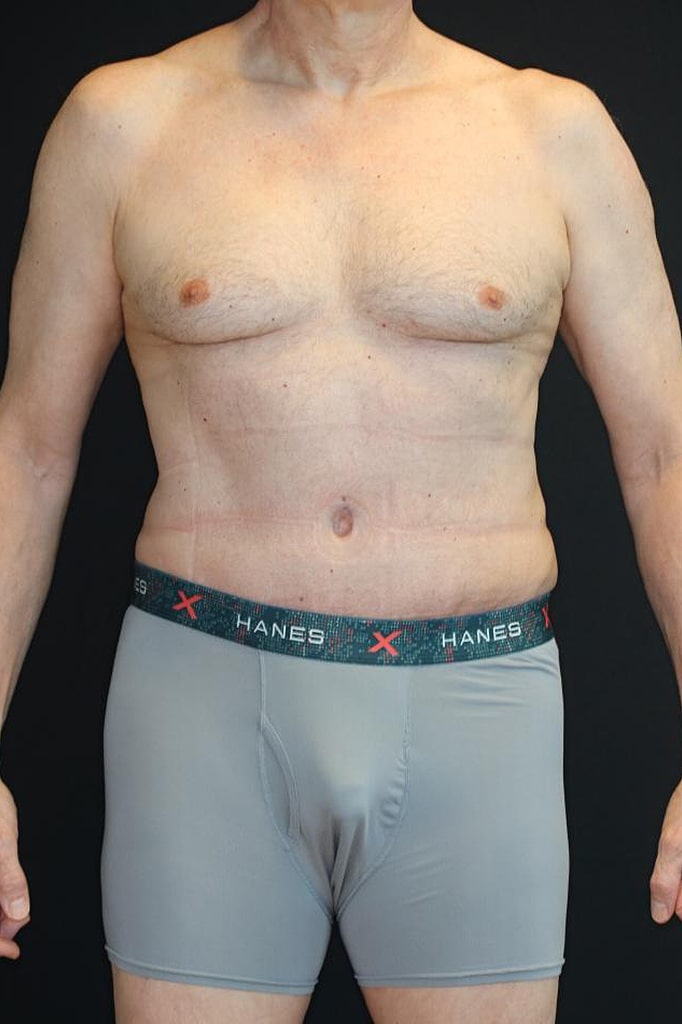 After Image: Patient #4160 - front