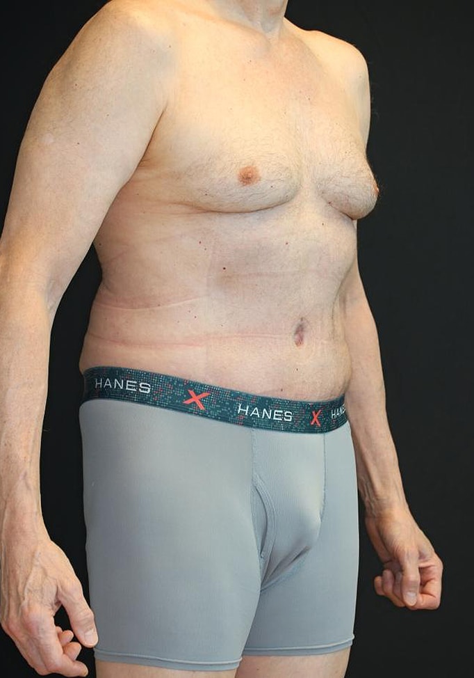 After Image: Patient #4160 - right-front-oblique