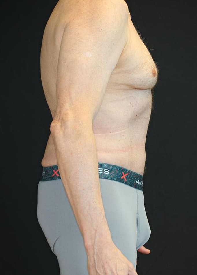 After Image: Patient #4160 - right-side