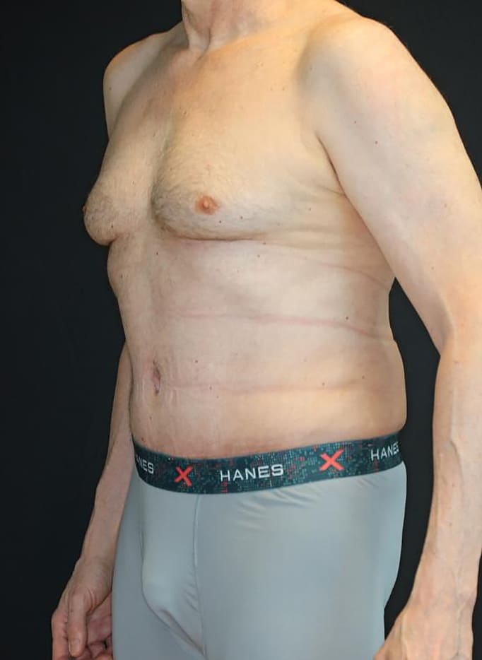 After Image: Patient #4160 - left-front-oblique