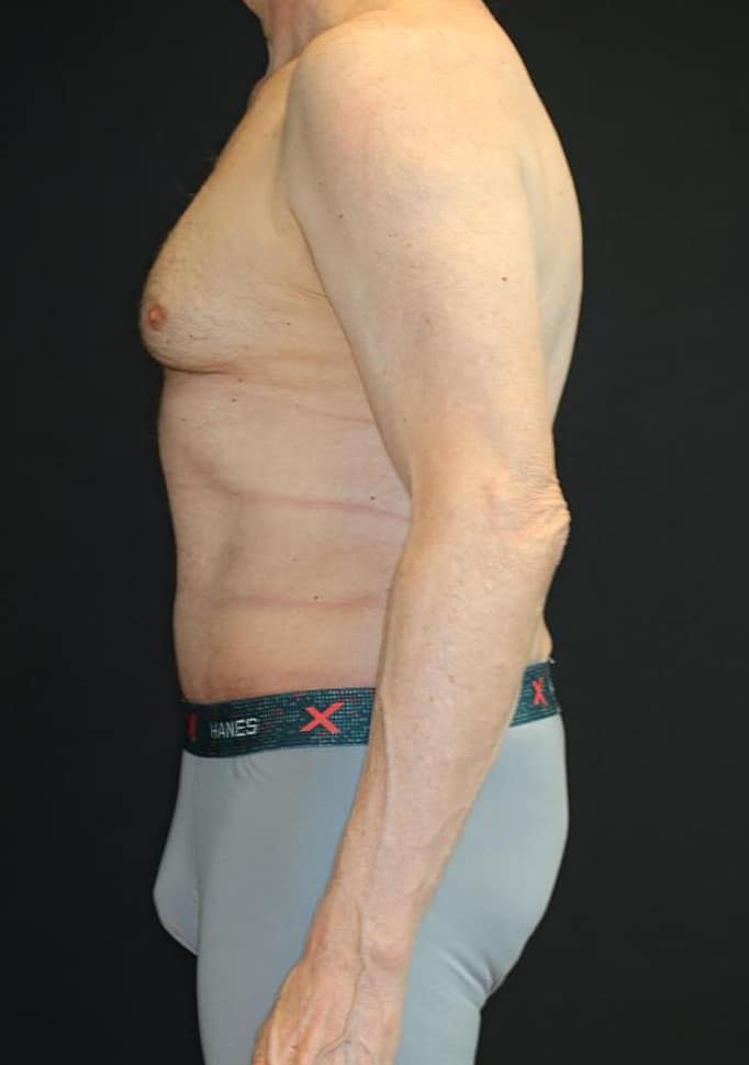 After Image: Patient #4160 - left-side