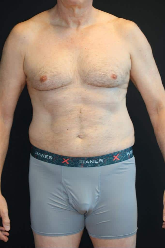 Before Image: Patient #4160 - front