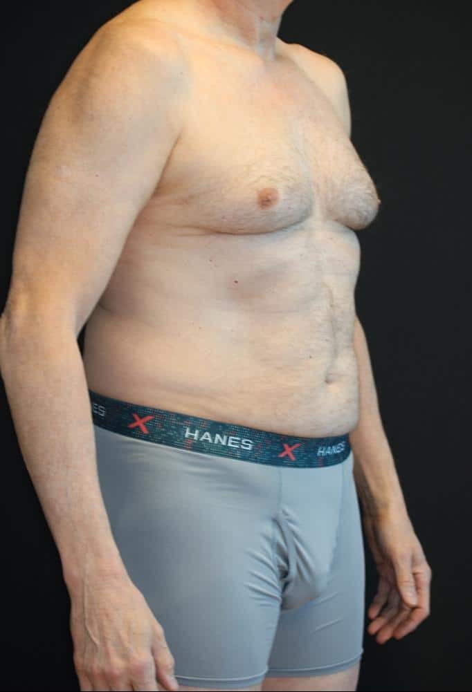 Before Image: Patient #4160 - right-front-oblique