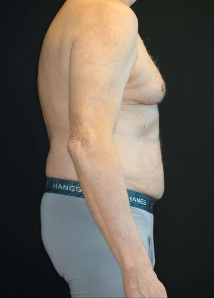 Before Image: Patient #4160 - right-side