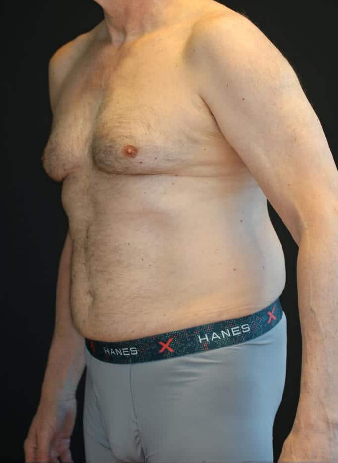 Before Image: Patient #4160 - left-front-oblique