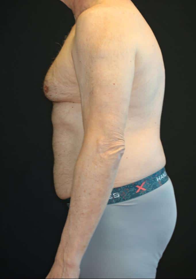 Before Image: Patient #4160 - left-side