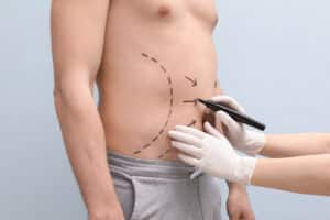Doctor marking up man's abdomen to prepare for male body contouring procedure