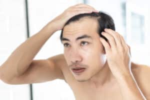 Man examining his receding hairline in the mirror, concerned about early signs of hair loss