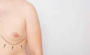 Male chest with visible fullness and surgical markings, indicating potential gynecomastia treatment area