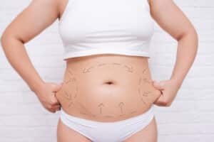Woman pinching abdominal skin with surgical markings on her stomach before mommy makeover procedure